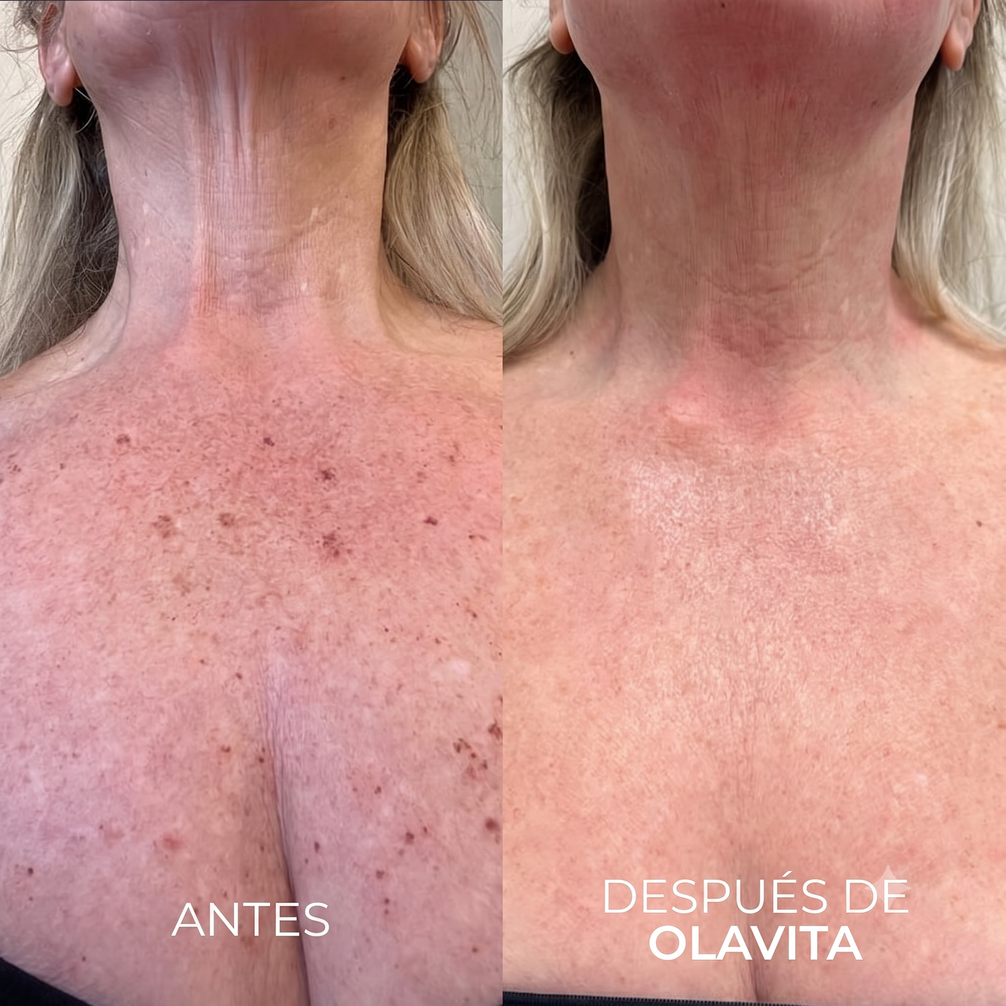 Alovita® Combate el melasma corporal desde las células