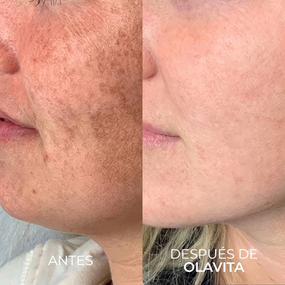 Alovita® Combate el melasma corporal desde las células