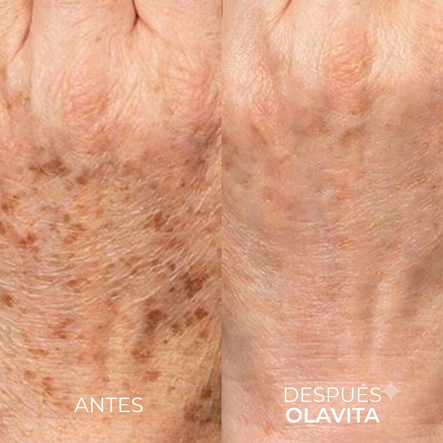 Alovita® Combate el melasma corporal desde las células